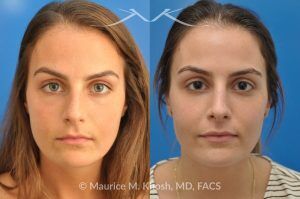 Photo of a patient before and after a procedure. Natural Result After Rhinoplasty for Nose Hump Correction - before-and-after composite photo.