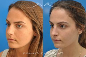 Photo of a patient before and after a procedure. Natural Result After Rhinoplasty for Nose Hump Correction - before-and-after composite photo.