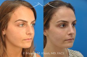Photo of a patient before and after a procedure. Natural Result After Rhinoplasty for Nose Hump Correction - before-and-after composite photo.