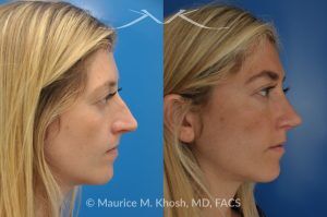 Photo of a patient before and after a procedure. Open Rhinoplasty to Refine a Narrow and Long Nose with Tip Shortening - his 26 year old was interested in nose job in New York, in order to reduce her nasal hump, and make the nasal tip shorter and more refined. She underwent an open approach rhinoplasty which included shortening of the septum, removing the medial crura foot plates, and narrowing the nostrils.