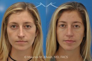 Photo of a patient before and after a procedure. Open Rhinoplasty to Refine a Narrow and Long Nose with Tip Shortening - his 26 year old was interested in nose job in New York, in order to reduce her nasal hump, and make the nasal tip shorter and more refined. She underwent an open approach rhinoplasty which included shortening of the septum, removing the medial crura foot plates, and narrowing the nostrils.