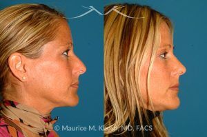 Photo of a patient before and after a procedure. Rhinoplasty for Tip & Dorsum - This patient was interested in addressing the hump on her nose and reducing the columellar show (hanging columella). Surgery was performed via the closed rhinoplasty approach.
