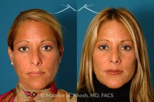 Photo of a patient before and after a procedure. Rhinoplasty for Tip & Dorsum - This patient was interested in addressing the hump on her nose and reducing the columellar show (hanging columella). Surgery was performed via the closed rhinoplasty approach.