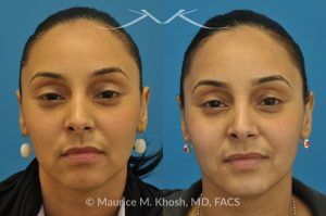 Photo of a patient before and after a procedure. Rhinoplasty to Remove Nasal Hump - This young lady with Hispanic ethnicity was interested in removing a small hump in the nose. Rhinoplasty was performed through a closed (endonasal) approach.