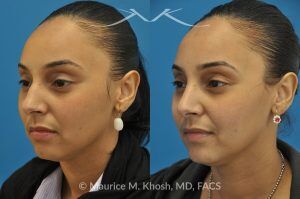 Photo of a patient before and after a procedure. Rhinoplasty to Remove Nasal Hump - This young lady with Hispanic ethnicity was interested in removing a small hump in the nose. Rhinoplasty was performed through a closed (endonasal) approach.