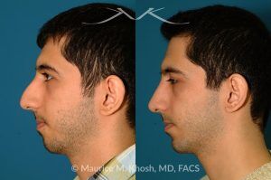 Photo of a patient before and after a procedure. Rhinoplasty and Chin Implant - before-and-after composite photo.