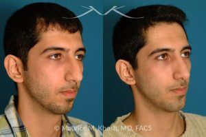 Photo of a patient before and after a procedure. Rhinoplasty and Chin Implant - before-and-after composite photo.