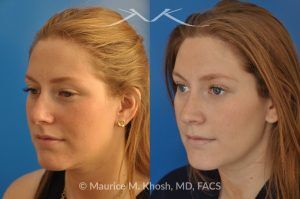 Photo of a patient before and after a procedure. Rhinoplasty to Correct Crooked Nose and Remove Hump - 26 year old with crooked nose to the right side and a small hump. She was seeking rhinoplasty in Manhattan to straighten the nose remove a hump. She was treated with closed rhinoplasty which allowed reduction of the hump, a cartilage spreader graft on the left side, and a columellar strut.