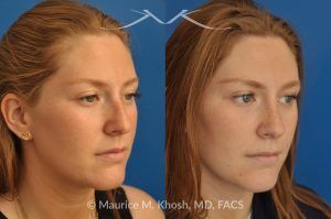 Photo of a patient before and after a procedure. Rhinoplasty to Correct Crooked Nose and Remove Hump - 26 year old with crooked nose to the right side and a small hump. She was seeking rhinoplasty in Manhattan to straighten the nose remove a hump. She was treated with closed rhinoplasty which allowed reduction of the hump, a cartilage spreader graft on the left side, and a columellar strut.