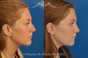 Photo of a patient before and after a procedure. Rhinoplasty to Correct Crooked Nose and Remove Hump - 26 year old with crooked nose to the right side and a small hump. She was seeking rhinoplasty in Manhattan to straighten the nose remove a hump. She was treated with closed rhinoplasty which allowed reduction of the hump, a cartilage spreader graft on the left side, and a columellar strut.