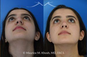 Photo of a patient before and after a procedure. Rhinoplasty to Remove Dorsal Hump and Refine Nasal Tip - This 18 year-old was interested in rhinoplasty in New York to eliminate her nasal hump, narrow and refine the tip, and address deviated septum which caused breathing obstruction and asymmetric nostrils. An open approach rhinoplasty was used to address all her concerns. 