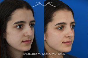 Photo of a patient before and after a procedure. Rhinoplasty to Remove Dorsal Hump and Refine Nasal Tip - This 18 year-old was interested in rhinoplasty in New York to eliminate her nasal hump, narrow and refine the tip, and address deviated septum which caused breathing obstruction and asymmetric nostrils. An open approach rhinoplasty was used to address all her concerns. 