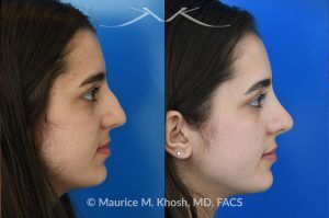 Photo of a patient before and after a procedure. Rhinoplasty to Remove Dorsal Hump and Refine Nasal Tip - This 18 year-old was interested in rhinoplasty in New York to eliminate her nasal hump, narrow and refine the tip, and address deviated septum which caused breathing obstruction and asymmetric nostrils. An open approach rhinoplasty was used to address all her concerns. 