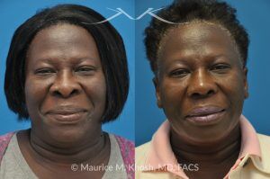 Photo of a patient before and after a procedure. Rhinoplasty to Narrow the Nostrils and Refine the Tip - before-and-after composite photo.
