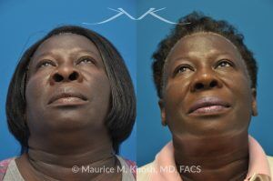 Photo of a patient before and after a procedure. Rhinoplasty to Narrow the Nostrils and Refine the Tip - before-and-after composite photo.