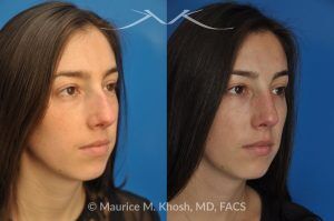 Photo of a patient before and after a procedure. Rhinoplasty to Remove Hump and Improve Breathing - This young lady in her twenties co breathing difficulty and a nasal bony hump. She underwent rhinoplasty through an endo-nasal or closed approach. He nasal hump was removed. She also had cartilage grafts (right sided spreader graft and bilateral alar strut grafts) to support her nasal valve patency.