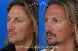 Photo of a patient before and after a procedure. Rhinoplasty for Crooked Nose and Nasal Obstruction - This 44 year old had suffered multiple nose fractures as a young adult. He complained of complete nasal obstruction due a severely deviated septum, and an extremely crooked nose. He was treated through an open rhinoplasty approach. Cadaver rib cartilage was used to straighten his severely deviated septum. Additional cartilage grafts to the bridge of the nose and the left alar region allowed the correction of his functional and cosmetic concerns. He is ecstatic with his results. 