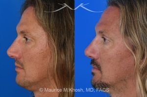 Photo of a patient before and after a procedure. Rhinoplasty for Crooked Nose and Nasal Obstruction - This 44 year old had suffered multiple nose fractures as a young adult. He complained of complete nasal obstruction due a severely deviated septum, and an extremely crooked nose. He was treated through an open rhinoplasty approach. Cadaver rib cartilage was used to straighten his severely deviated septum. Additional cartilage grafts to the bridge of the nose and the left alar region allowed the correction of his functional and cosmetic concerns. He is ecstatic with his results. 