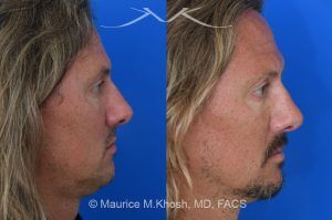 Photo of a patient before and after a procedure. Rhinoplasty for Crooked Nose and Nasal Obstruction - This 44 year old had suffered multiple nose fractures as a young adult. He complained of complete nasal obstruction due a severely deviated septum, and an extremely crooked nose. He was treated through an open rhinoplasty approach. Cadaver rib cartilage was used to straighten his severely deviated septum. Additional cartilage grafts to the bridge of the nose and the left alar region allowed the correction of his functional and cosmetic concerns. He is ecstatic with his results. 