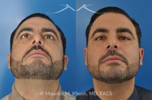 Photo of a patient before and after a procedure. Rhinoplasty for Subtle Reduction of the Dorsal Hump and Tip Elevation - before-and-after composite photo.