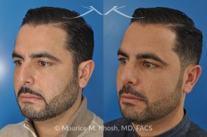 Photo of a patient before and after a procedure. Rhinoplasty for Subtle Reduction of the Dorsal Hump and Tip Elevation - before-and-after composite photo.