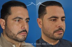 Photo of a patient before and after a procedure. Rhinoplasty for Subtle Reduction of the Dorsal Hump and Tip Elevation - before-and-after composite photo.