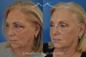 Photo of a patient before and after a procedure. Botox for Brow and Smile Lines with Voluma Filler - Patient treated with Botox for the brow and smile lines, and Voluma facial filler for the cheeks, temples, tear trough, and side of the lower jaw. Although no eyelid surgery was performed, the lower eyelids appear rejuvenated.