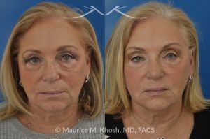 Photo of a patient before and after a procedure. Botox for Brow and Smile Lines with Voluma Filler - Patient treated with Botox for the brow and smile lines, and Voluma facial filler for the cheeks, temples, tear trough, and side of the lower jaw. Although no eyelid surgery was performed, the lower eyelids appear rejuvenated.
