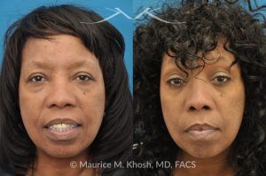 Photo of a patient before and after a procedure. Lower Eyelid Rejuvenation and Temporal Brow Lift - This 55 year old African American lady was interested to addressing lower eyelid puffiness and sagging eyebrow. She underwent lower lid rejuvenation through a trans-conjunctival (inside the eyelid) blepharoplasty and a temporal brow lift.