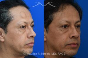 Photo of a patient before and after a procedure. Endoscopic Forehead Lipoma Removal with Hidden Hairline Incision - The lipoma in this picture had been enlarging over a number of years. The patient wished to avoid a visible scar in the forehead. We utilized an endoscopic approach within the hairline to remove this large lipoma. The forehead is now perfectly smooth and there is NO visible scar from the endoscopic approach. 
