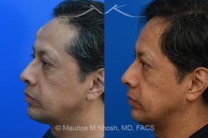 Photo of a patient before and after a procedure. Endoscopic Forehead Lipoma Removal with Hidden Hairline Incision - The lipoma in this picture had been enlarging over a number of years. The patient wished to avoid a visible scar in the forehead. We utilized an endoscopic approach within the hairline to remove this large lipoma. The forehead is now perfectly smooth and there is NO visible scar from the endoscopic approach. 