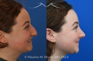 Photo of a patient before and after a procedure. Rhinoplasty for Droopy Tip and Nasal Hump - This delightful 18 year old was not happy with the external appearance of her nose. She disliked the nasal hump, the droopy tip, and the ''unrefined'' shape of her nose. She underwent an open approach rhinoplasty in New York. The dorsal height was reduced, the nasal tip was elevated, and the tip was narrowed and refined. The post op pictures show her at 2 years post op. She is ecstatic with the outcome of her rhinoplasty.