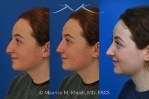 Photo of a patient before and after a procedure. Rhinoplasty for Droopy Tip and Nasal Hump - This delightful 18 year old was not happy with the external appearance of her nose. She disliked the nasal hump, the droopy tip, and the ''unrefined'' shape of her nose. She underwent an open approach rhinoplasty in New York. The dorsal height was reduced, the nasal tip was elevated, and the tip was narrowed and refined. The post op pictures show her at 2 years post op. She is ecstatic with the outcome of her rhinoplasty.