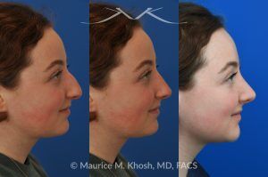 Photo of a patient before and after a procedure. Rhinoplasty for Droopy Tip and Nasal Hump - This delightful 18 year old was not happy with the external appearance of her nose. She disliked the nasal hump, the droopy tip, and the ''unrefined'' shape of her nose. She underwent an open approach rhinoplasty in New York. The dorsal height was reduced, the nasal tip was elevated, and the tip was narrowed and refined. The post op pictures show her at 2 years post op. She is ecstatic with the outcome of her rhinoplasty.