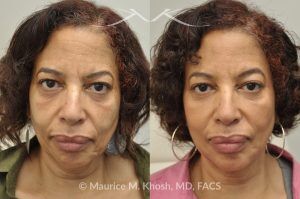 Photo of a patient before and after a procedure. Botox Injections for Frown Lines and Chin, Restylane Treatment for Cheeks and Marionette Lines - before and after photo.