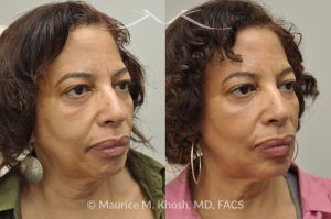 Photo of a patient before and after a procedure. Botox Injections for Frown Lines and Chin, Restylane Treatment for Cheeks and Marionette Lines - before and after photo.