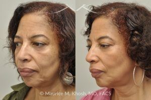Photo of a patient before and after a procedure. Botox Injections for Frown Lines and Chin, Restylane Treatment for Cheeks and Marionette Lines - before and after photo.