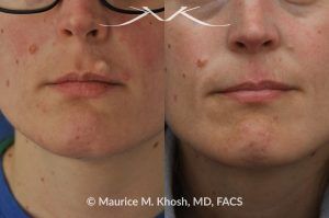Photo of a patient before and after a procedure. Upper Lip Cyst Removal - This procedure involved the excision of a cyst from the upper lip, successfully removing the growth and improving the appearance of the affected area.