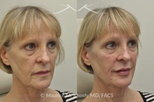Photo of a patient before and after a procedure. Juvederm Facial Filler Injections for Cheeks, Lips, and Orbital Hollows - before and after photo.