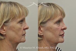 Photo of a patient before and after a procedure. Juvederm Facial Filler Injections for Cheeks, Lips, and Orbital Hollows - before and after photo.