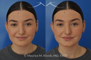 Photo of a patient before and after a procedure. Lip Augmentation with Volbella Filler for Symmetry and Volume - This young lady was interested in enhancing the appearance of her lips. She was  noted to have small calibered and asymmetric upper lip. A hyaluronic acid filler (Volbella) was used to augment the upper and lower lips. Precise placement of the filler not only created fuller lips, it also allowed creation of symmetry in the upper lip.