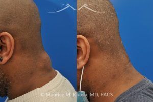 Photo of a patient before and after a procedure. Posterior Neck Lipoma Removal - 44 year old with recurrent lipoma in the posterior aspect of the neck requested lipoma removal in our New York office. The right side photos demonstrate the successful outcome of surgery 4 months post op.