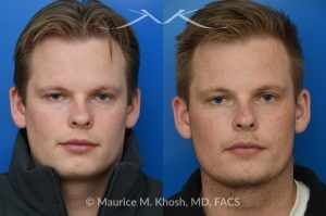 Photo of a patient before and after a procedure. Rhinoplasty with Spreader Graft Improved Symmetry and Breathing - This young patient presented with complaints of nasal obstruction and asymmetric nasal appearance on front view. He had a severe septum deviation and narrowing of the right internal nasal valve due to medial positioning of the upper lateral cartilage. Surgery was performed through a closed approach. Septoplasty was followed by placement of a spreader graft on the right side. The spreader graft not only improved breathing, it also widened the right middle vault and enhanced symmetry of the upper nose in the frontal view.