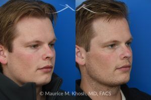 Photo of a patient before and after a procedure. Rhinoplasty with Spreader Graft Improved Symmetry and Breathing - This young patient presented with complaints of nasal obstruction and asymmetric nasal appearance on front view. He had a severe septum deviation and narrowing of the right internal nasal valve due to medial positioning of the upper lateral cartilage. Surgery was performed through a closed approach. Septoplasty was followed by placement of a spreader graft on the right side. The spreader graft not only improved breathing, it also widened the right middle vault and enhanced symmetry of the upper nose in the frontal view.