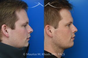 Photo of a patient before and after a procedure. Rhinoplasty with Spreader Graft Improved Symmetry and Breathing - This young patient presented with complaints of nasal obstruction and asymmetric nasal appearance on front view. He had a severe septum deviation and narrowing of the right internal nasal valve due to medial positioning of the upper lateral cartilage. Surgery was performed through a closed approach. Septoplasty was followed by placement of a spreader graft on the right side. The spreader graft not only improved breathing, it also widened the right middle vault and enhanced symmetry of the upper nose in the frontal view.