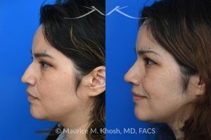 Photo of a patient before and after a procedure. Rhinoplasty For Tip Enhancement Dorsal Hump Reduction And Nostril Narrowing - This rhinoplasty was performed using an open approach. The procedure included reducing the nasal bridge and placing cartilage grafts to support and refine the middle portion of the nose. Controlled bone cuts (osteotomies) were made to narrow the upper nose. The tip was reshaped by trimming and refining the cartilage, placing sutures to create a more defined contour, and flattening the nostrils for balance. Additional support was achieved with a septal extension graft, and the nostril bases were reduced for improved proportion.

The final images display the nose before surgery, the computer-simulated projections, and the achieved postoperative results.