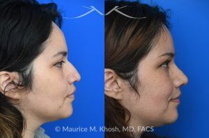 Photo of a patient before and after a procedure. Rhinoplasty For Tip Enhancement Dorsal Hump Reduction And Nostril Narrowing - This rhinoplasty was performed using an open approach. The procedure included reducing the nasal bridge and placing cartilage grafts to support and refine the middle portion of the nose. Controlled bone cuts (osteotomies) were made to narrow the upper nose. The tip was reshaped by trimming and refining the cartilage, placing sutures to create a more defined contour, and flattening the nostrils for balance. Additional support was achieved with a septal extension graft, and the nostril bases were reduced for improved proportion.

The final images display the nose before surgery, the computer-simulated projections, and the achieved postoperative results.
