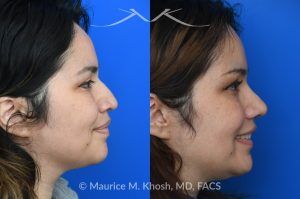 Photo of a patient before and after a procedure. Rhinoplasty For Tip Enhancement Dorsal Hump Reduction And Nostril Narrowing - This rhinoplasty was performed using an open approach. The procedure included reducing the nasal bridge and placing cartilage grafts to support and refine the middle portion of the nose. Controlled bone cuts (osteotomies) were made to narrow the upper nose. The tip was reshaped by trimming and refining the cartilage, placing sutures to create a more defined contour, and flattening the nostrils for balance. Additional support was achieved with a septal extension graft, and the nostril bases were reduced for improved proportion.

The final images display the nose before surgery, the computer-simulated projections, and the achieved postoperative results.