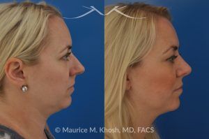 Photo of a patient before and after a procedure. Bilateral Nasal Valve Repair - In this patient, rhinoplasty and septoplasty were performed to improve nasal breathing, reduce a moderate dorsal hump, and refine the nasal tip. Using an open approach, the procedure involved dorsal reduction, placement of spreader grafts to support the internal nasal valves, and comprehensive tip modification. The nasal tip was narrowed, de-projected, and slightly elevated to achieve improved balance and harmony with the rest of the nasal framework.
