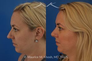 Photo of a patient before and after a procedure. Bilateral Nasal Valve Repair - In this patient, rhinoplasty and septoplasty were performed to improve nasal breathing, reduce a moderate dorsal hump, and refine the nasal tip. Using an open approach, the procedure involved dorsal reduction, placement of spreader grafts to support the internal nasal valves, and comprehensive tip modification. The nasal tip was narrowed, de-projected, and slightly elevated to achieve improved balance and harmony with the rest of the nasal framework.